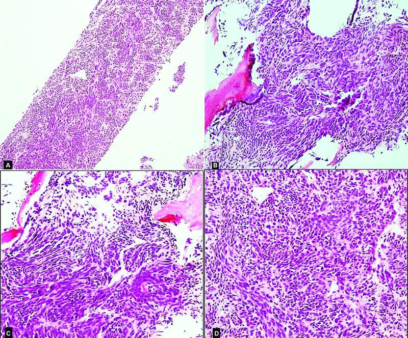 Amelanotic Melanoma: A Great Masquerader.