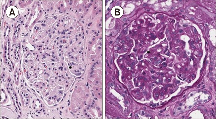 A case report of thrombotic thrombocytopenic purpura-like syndrome after Coronavirus disease 2019 vaccination.