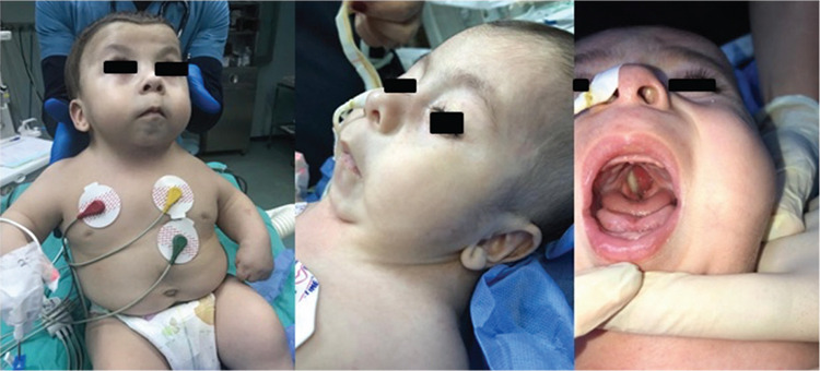 Challenging Anaesthesia Management of a Patient with Fryns Syndrome: A Case Report.