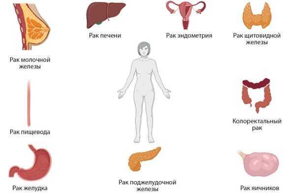 [Diabetes mellitus and the female reproductive system tumors].