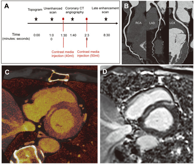 Myocardial Late Iodine Enhancement Using Photon-Counting Computed Tomography in Patients With Hypertrophic Cardiomyopathy.