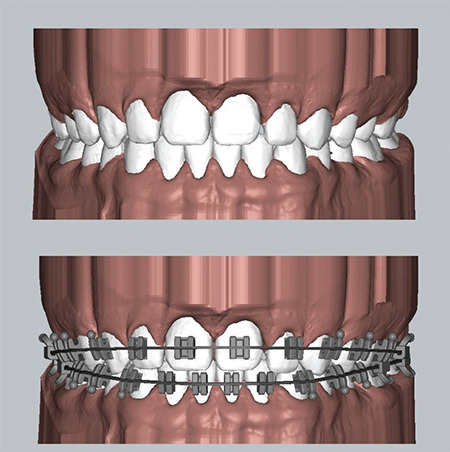 In-office Customized Brackets: Aligning with the Future.