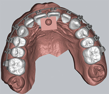 In-office Customized Brackets: Aligning with the Future.