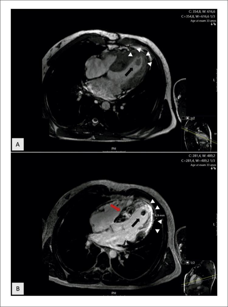 An Atypical Non-Cardiac Presentation of Hypertrophic Cardiomyopathy.