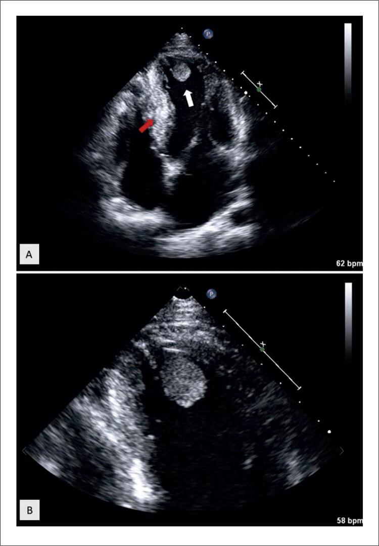 An Atypical Non-Cardiac Presentation of Hypertrophic Cardiomyopathy.