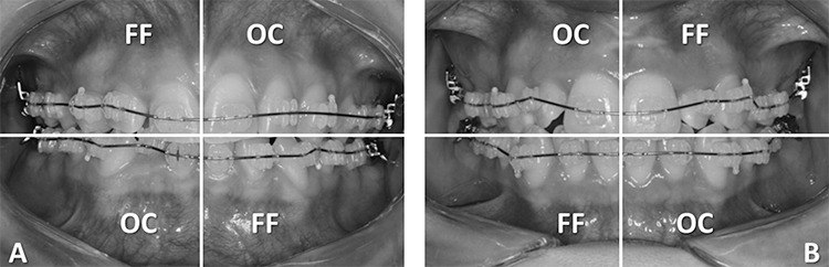 Evaluation of the Flash-Free Adhesive System for a 6-month Period: A Split-Mouth Trial.