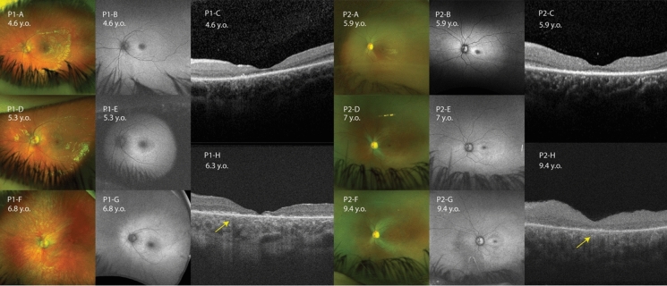 Early recognition of CLN3 disease facilitated by visual electrophysiology and multimodal imaging.