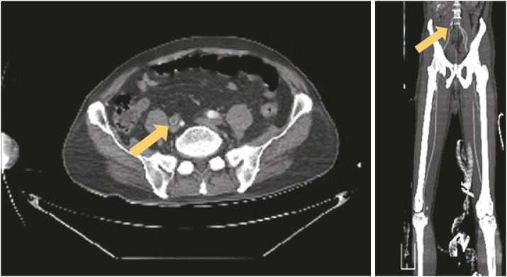 Right Common Iliac Artery Occlusion in a Patient with Severe COVID-19.