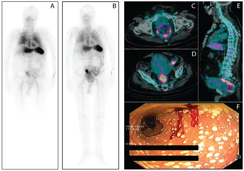 Unusual Case of Pseudomembranous Colitis Presenting as Fever of Unknown Origin Diagnosed by Tc-99m-HMPAO-labeled Leukocytes SPECT/CT.