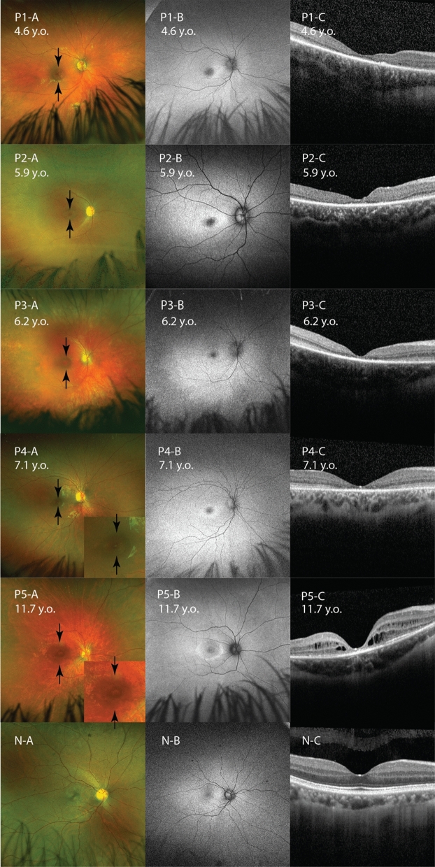 Early recognition of CLN3 disease facilitated by visual electrophysiology and multimodal imaging.