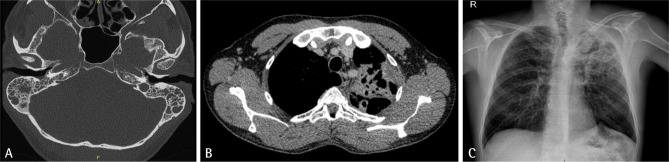 [Tuberculous otomastoiditis: a case report].