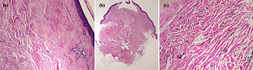 Generalized morphea induced by the COVID-19 vaccine in a patient with chronic urticaria.