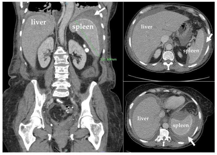 Splenic Rupture Secondary to Amyloidosis: A Case Report and Review of the Literature.