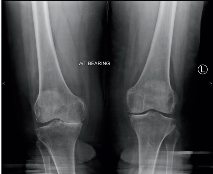 Is There a Role for Ordering a DEXA (Dual Energy X-Ray Absorptiometry) Scan for Patients with Symptomatic Advanced Knee Osteoarthritis?