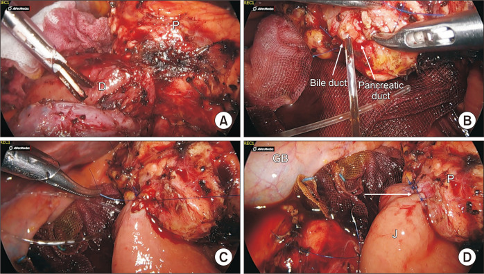 Laparoscopic pancreas-preserving near total duodenectomy for large villous adenoma in patients with total colectomy for familial adenomatous polyposis.