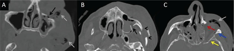 Brain Perfusion Changes in a Patient with Facial Trauma.