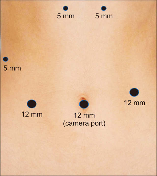 Laparoscopic pancreas-preserving near total duodenectomy for large villous adenoma in patients with total colectomy for familial adenomatous polyposis.