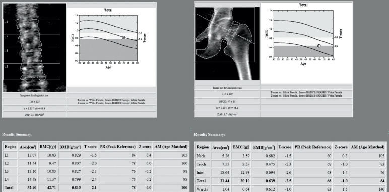 Is There a Role for Ordering a DEXA (Dual Energy X-Ray Absorptiometry) Scan for Patients with Symptomatic Advanced Knee Osteoarthritis?