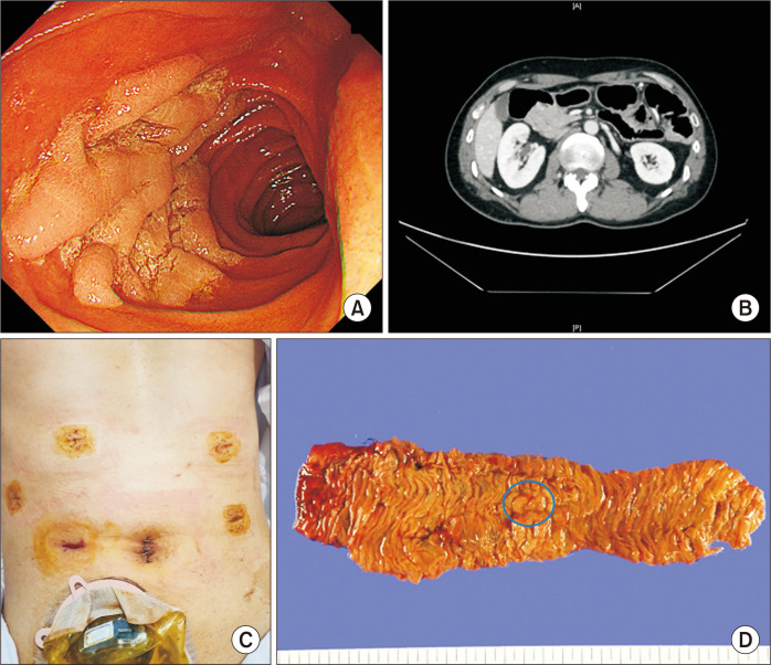 Laparoscopic pancreas-preserving near total duodenectomy for large villous adenoma in patients with total colectomy for familial adenomatous polyposis.