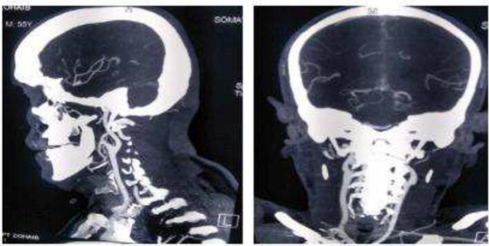 Battling the Eagle's sharp beak, Eagle syndrome; a case report