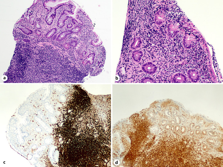 Not Everything That Ulcerates Is Crohn's Disease.