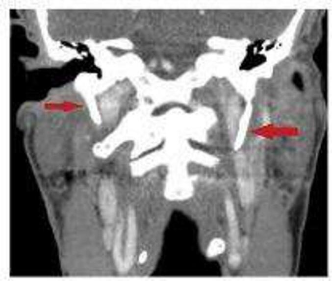 Battling the Eagle's sharp beak, Eagle syndrome; a case report