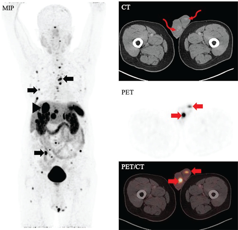 Testicular Metastasis of Jejunal Neuroendocrine Tumor on <sup>68</sup>Ga-DOTATATE PET/CT.