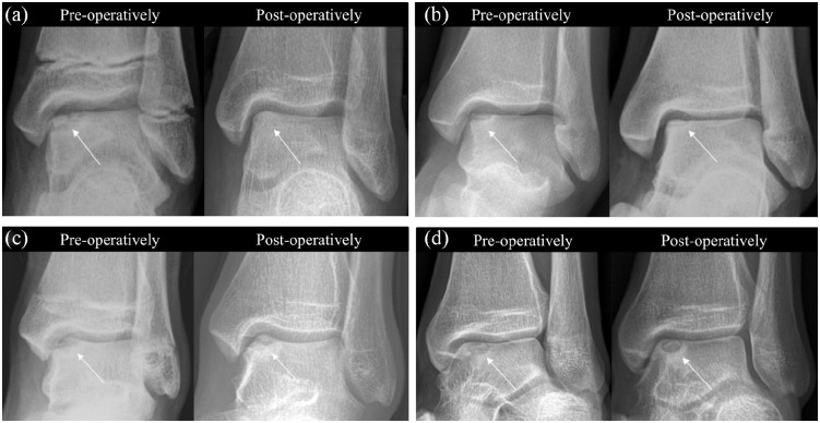 Clinical and radiological outcomes of surgically treated osteochondral lesions of the talus in children and adolescents.