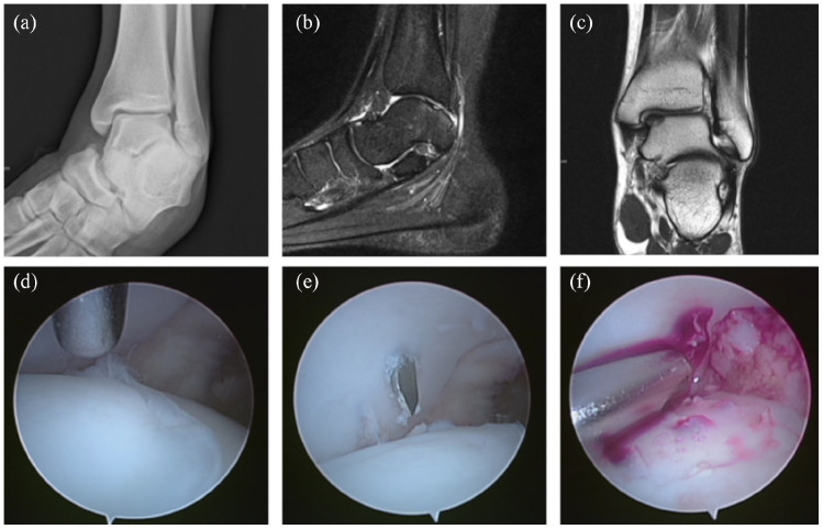 Clinical and radiological outcomes of surgically treated osteochondral lesions of the talus in children and adolescents.