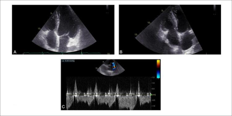 Carcinoid Heart Disease: A Case Report and Literature Review.