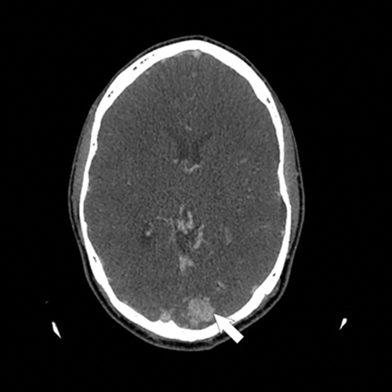 Idiopathic De Novo Arteriovenous Malformation: A Rare Acquired Intracranial Lesion.