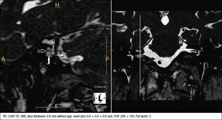 Does vestibular function correlate with objective MRI findings after vestibular schwannoma surgery?