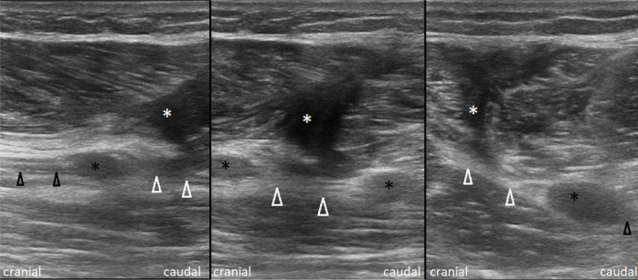 Considerations about the multidimensional evaluation of a stab wound tibial neuropathy: a case report.