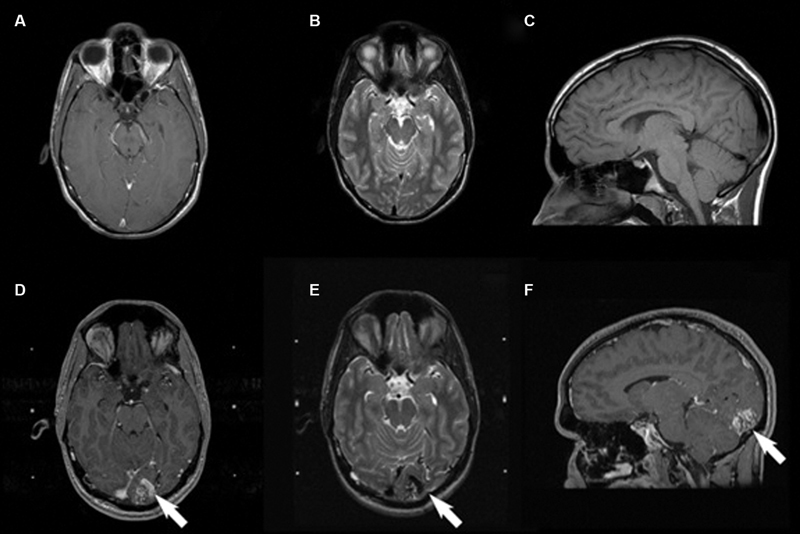 Idiopathic De Novo Arteriovenous Malformation: A Rare Acquired Intracranial Lesion.