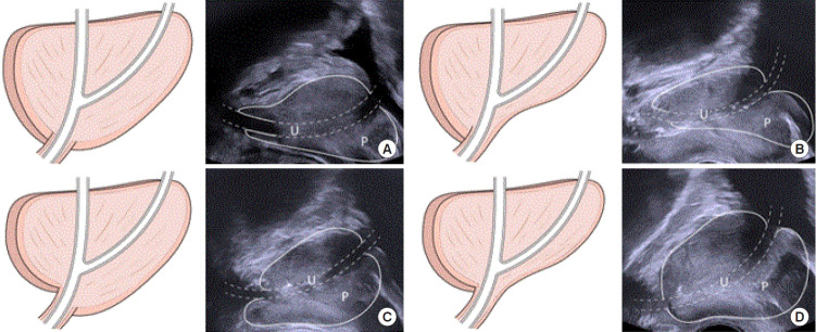 Comprehensive Analysis of Individual Anatomical Structures for Micturition Symptoms and Maximum Flow Rate in Men With Benign Prostatic Hyperplasia/Lower Urinary Tract Symptoms.