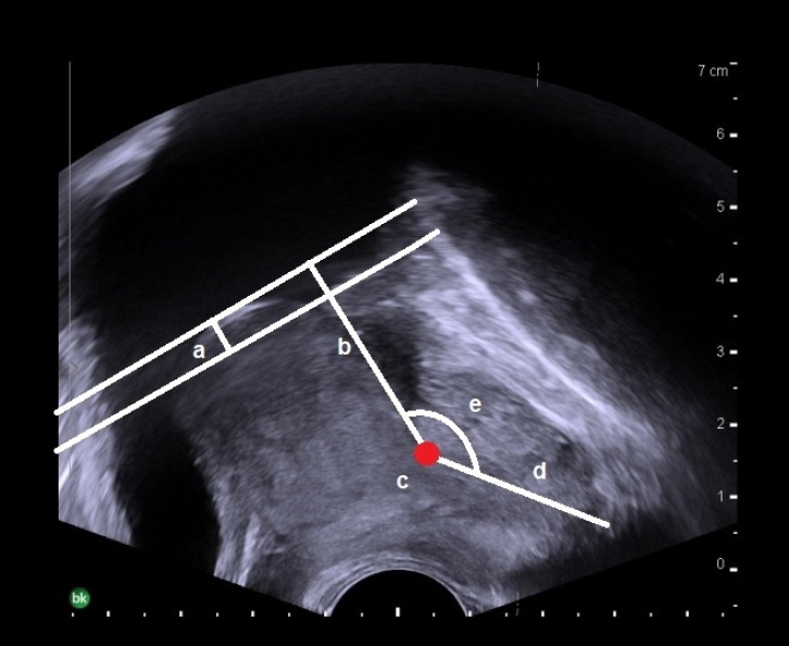 Comprehensive Analysis of Individual Anatomical Structures for Micturition Symptoms and Maximum Flow Rate in Men With Benign Prostatic Hyperplasia/Lower Urinary Tract Symptoms.