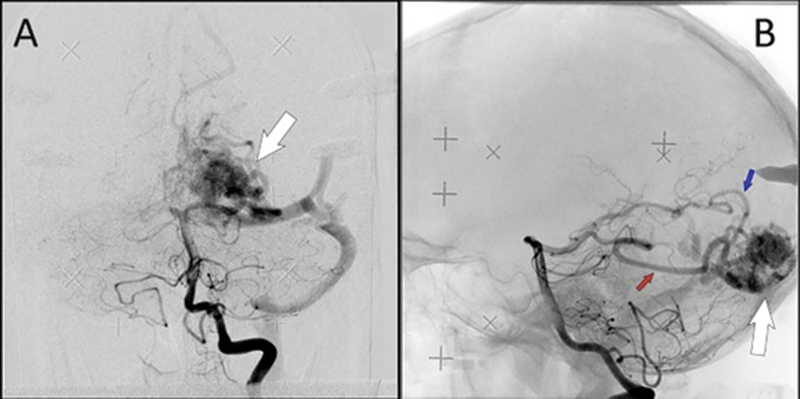 Idiopathic De Novo Arteriovenous Malformation: A Rare Acquired Intracranial Lesion.