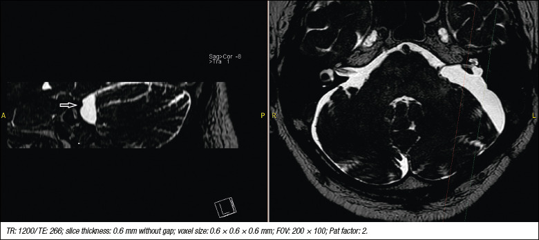 Does vestibular function correlate with objective MRI findings after vestibular schwannoma surgery?