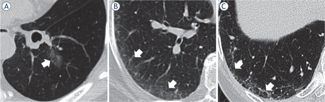 Subpleural fibrotic interstitial lung abnormalities are implicated in non-small cell lung cancer radiotherapy outcomes.