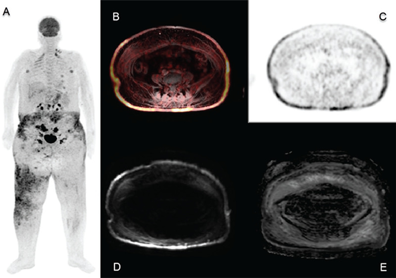 <sup>18</sup>F-FDG PET/MRI Image of Skin Metastasis of Ovarian Cancer.