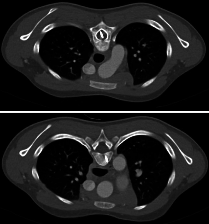Direct withdrawal of a retained foreign body bisecting the thoracic spinal canal in a neurologically intact pediatric patient: illustrative case.