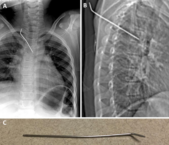 Direct withdrawal of a retained foreign body bisecting the thoracic spinal canal in a neurologically intact pediatric patient: illustrative case.