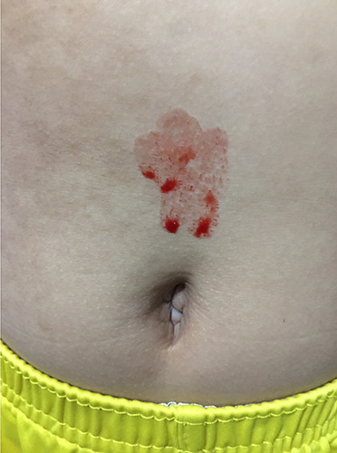 Hematohidrosis induced by separation anxiety disorder during COVID-19 quarantine: a case report and brief literature review.