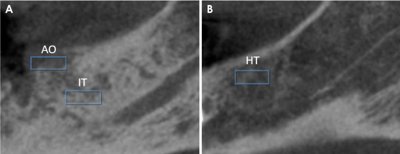 Texture analysis in cone-beam computed tomographic images of medication-related osteonecrosis of the jaw.