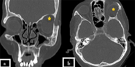 Endoscope-Assisted Removal of Post-Traumatic Orbital Epidermoid Inclusion Cyst: A Useful Adjunct.