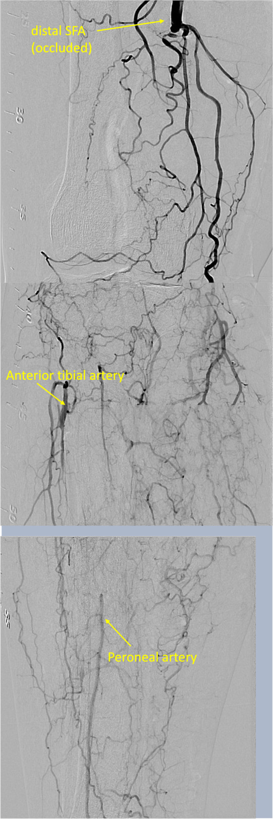 A case of chronic total occlusion in popliteal artery recanalized by double snare piercing technique.