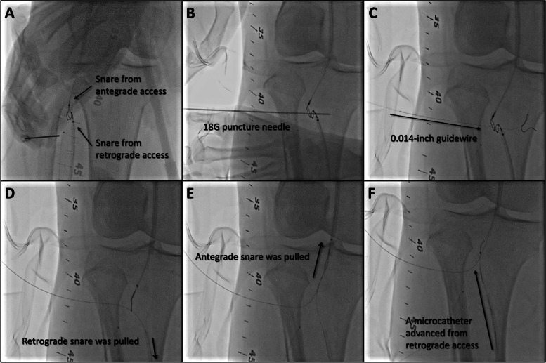 A case of chronic total occlusion in popliteal artery recanalized by double snare piercing technique.