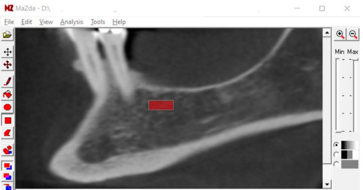 Texture analysis in cone-beam computed tomographic images of medication-related osteonecrosis of the jaw.