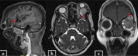 Endoscope-Assisted Removal of Post-Traumatic Orbital Epidermoid Inclusion Cyst: A Useful Adjunct.