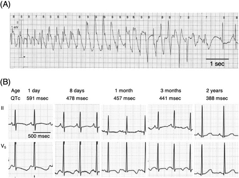 A novel HECW2 variant in an infant with congenital long QT syndrome.